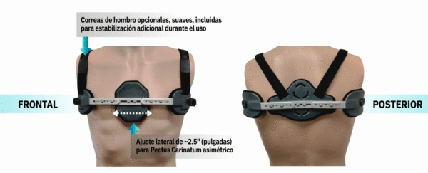 Órtesis de Pectus Carinatum- Pectus Pro y Pectus Pro S